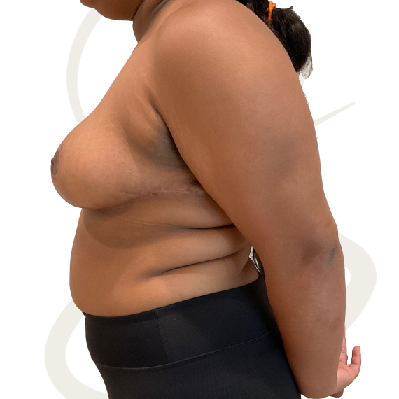 Breast Reduction Patient 13 After