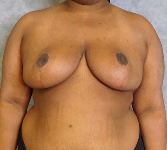 Breast Reduction Patient 12 After