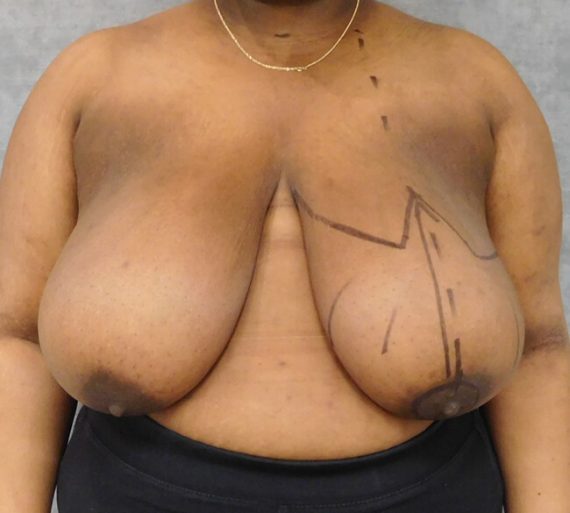 Breast Reduction Patient 12 Before