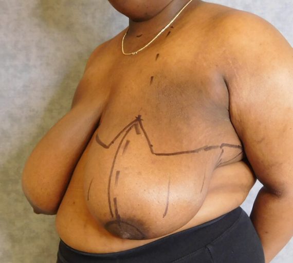 Breast Reduction Patient 12 Before