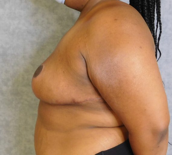 Breast Reduction Patient 12 After