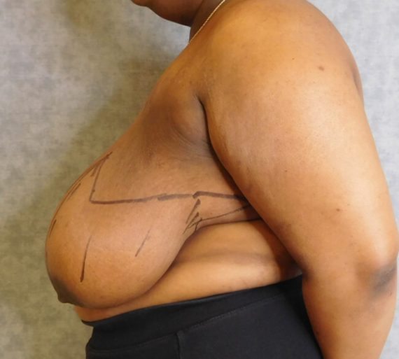 Breast Reduction Patient 12 Before