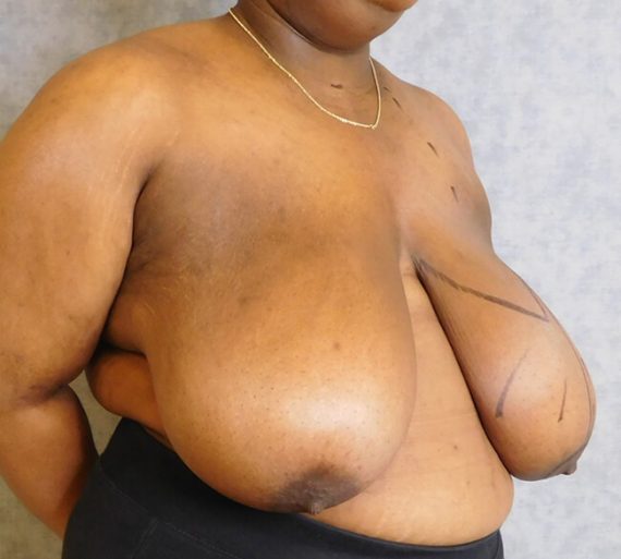 Breast Reduction Patient 12 Before