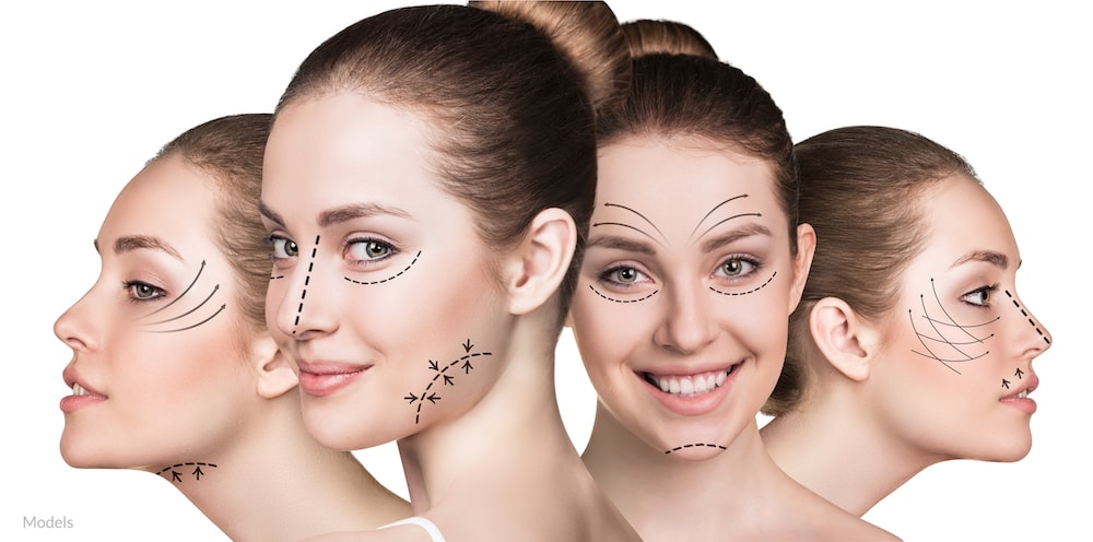 Surgical arrows drawn on facial contours that can be enhanced with plastic surgery.