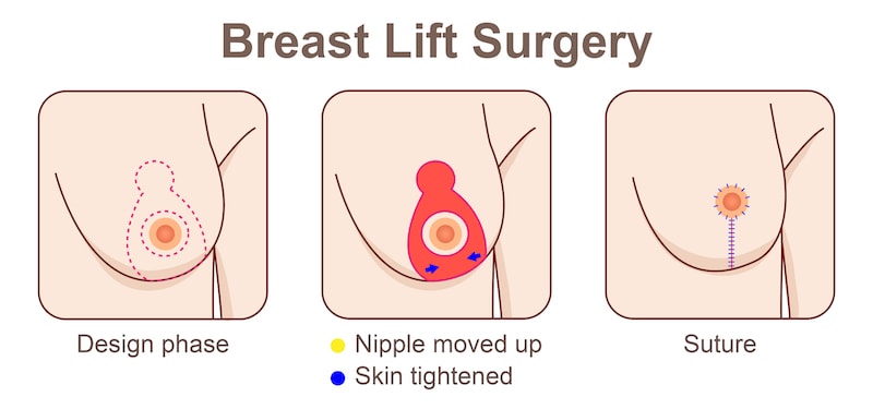 Illustration demonstrating the techniques used during a breast lift surgery.