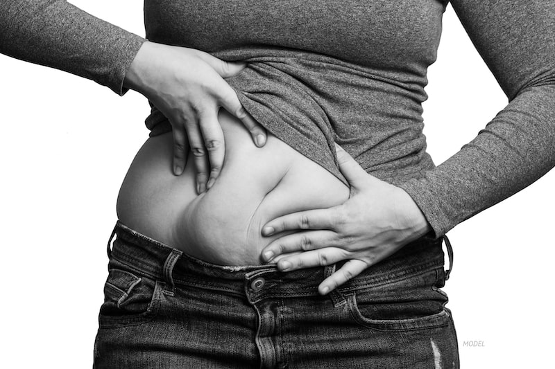 Woman pushing her belly fat together to show excess pooch.