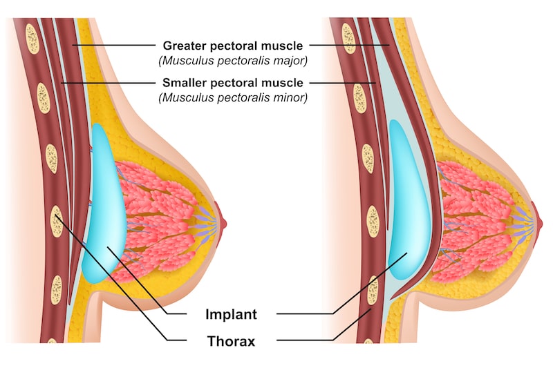 Vector illustration showing the placement of breast implants, above and below muscle
