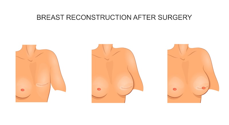 Illustration of three steps in breast reconstruction surgery.