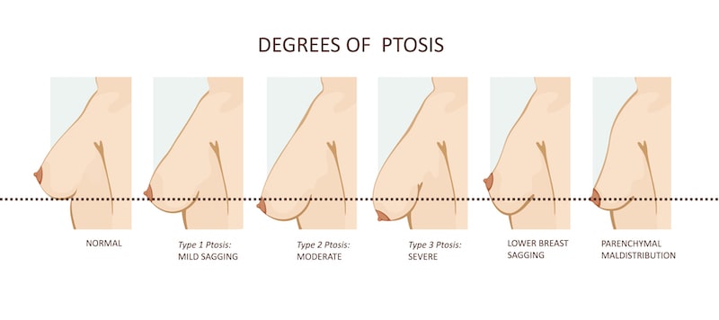 Illustration of different levels of breast ptosis