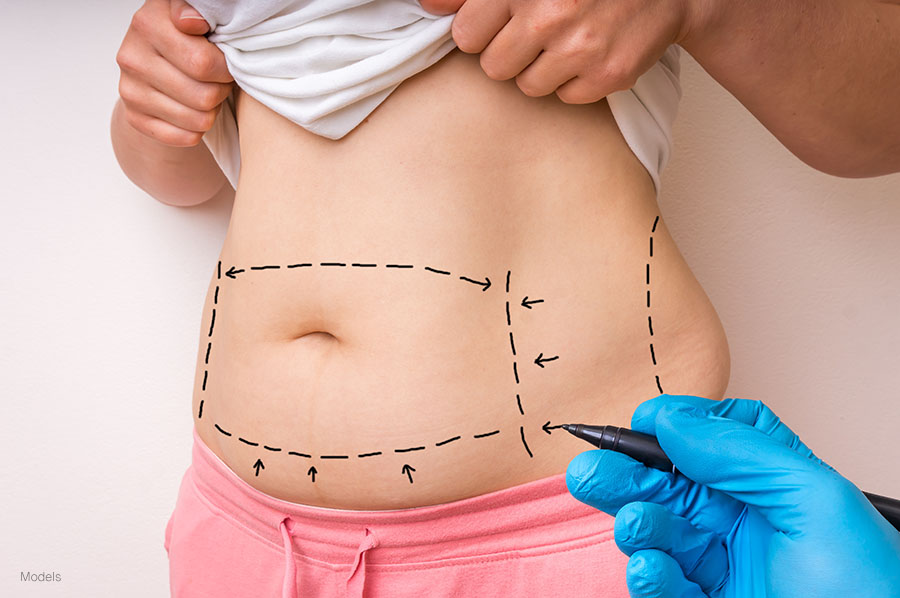 What Makes For The Perfect Tummy Tuck?