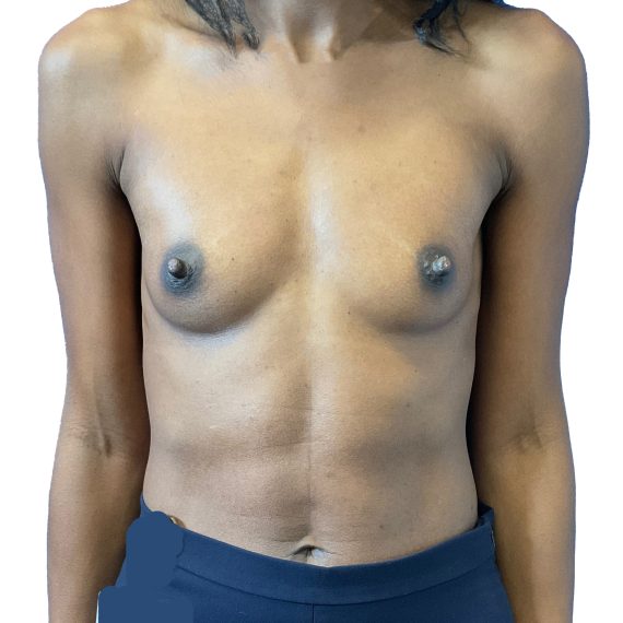 Breast Augmentation Patient 11 Before