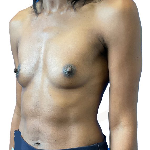 Breast Augmentation Patient 11 Before