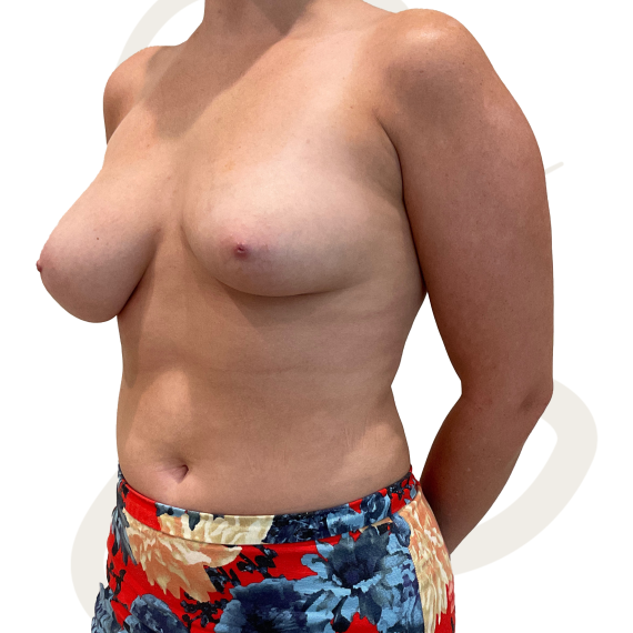 Breast Augmentation Patient 13 Before