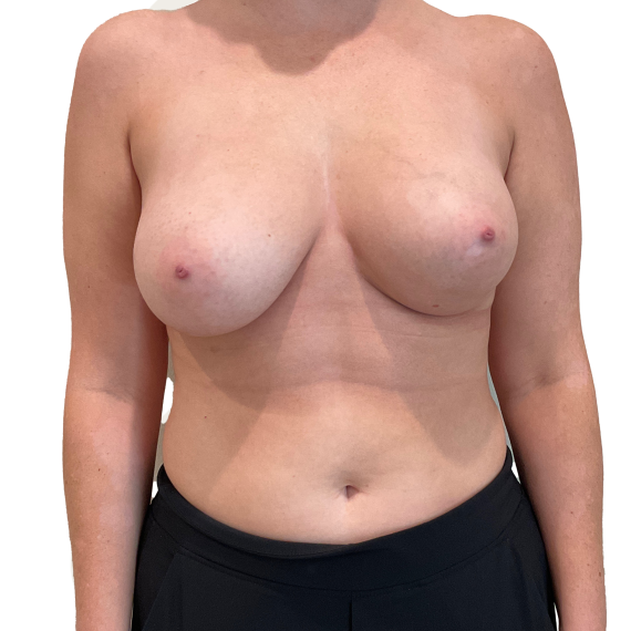 Breast Augmentation Patient 13 After