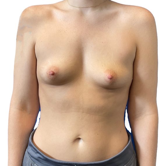 Breast Augmentation Patient 08 Before