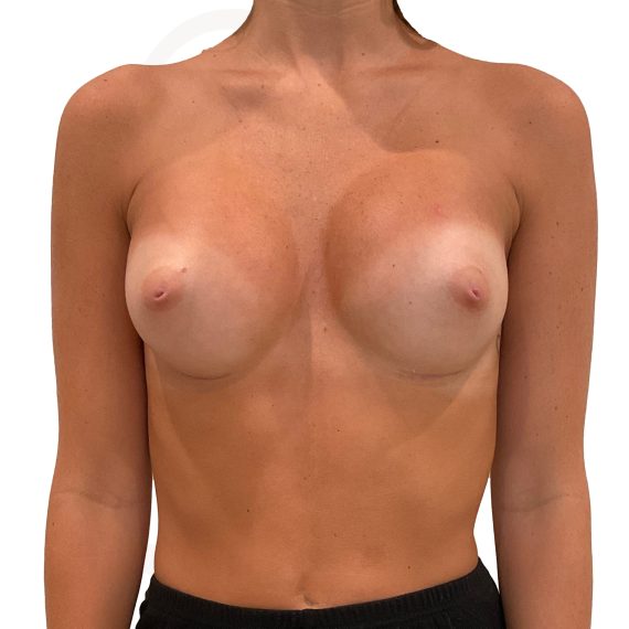Breast Augmentation Patient 09 After