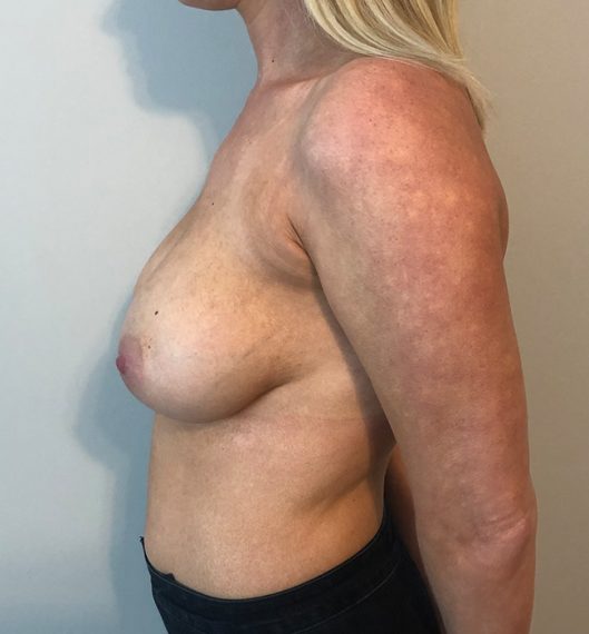Breast Augmentation Patient 01 After