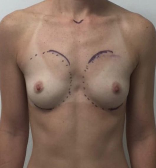 Breast Augmentation Patient 02 Before