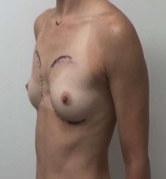 Breast Augmentation Patient 02 Before
