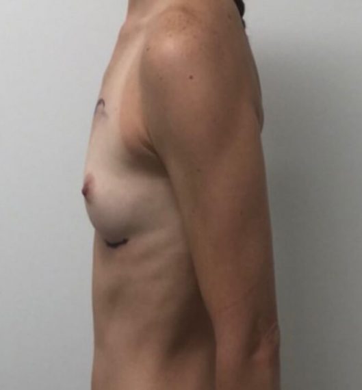 Breast Augmentation Patient 02 Before