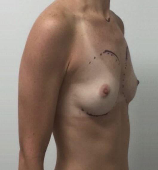 Breast Augmentation Patient 02 Before