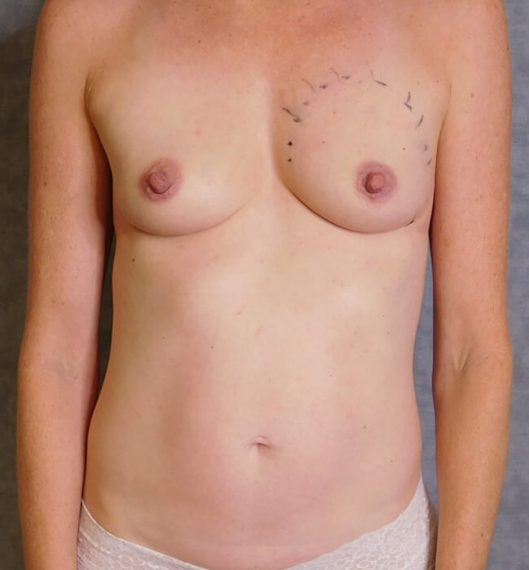 Breast Augmentation Patient 04 Before