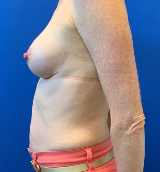 Breast Augmentation Patient 04 After