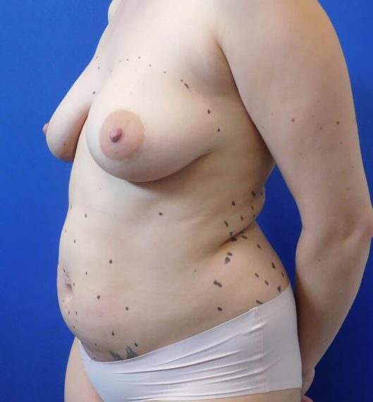 Breast Augmentation Patient 05 Before
