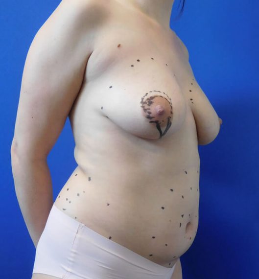Breast Augmentation Patient 05 Before