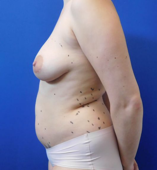 Breast Augmentation Patient 05 Before