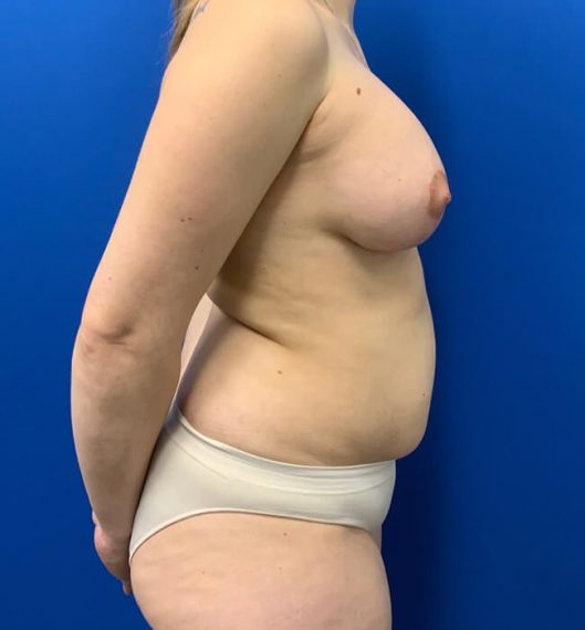 Breast Augmentation Patient 05 After