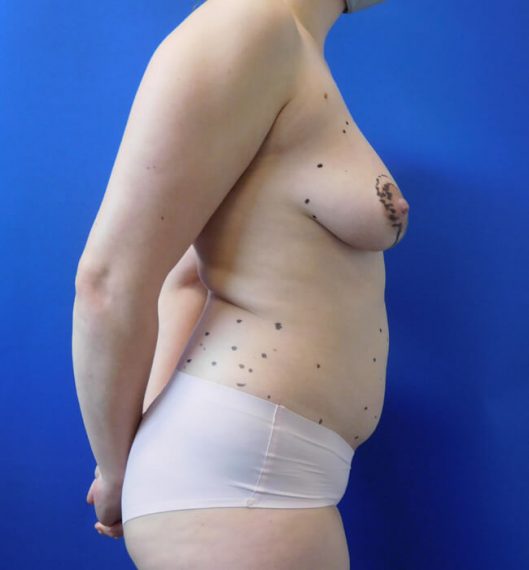 Breast Augmentation Patient 05 Before