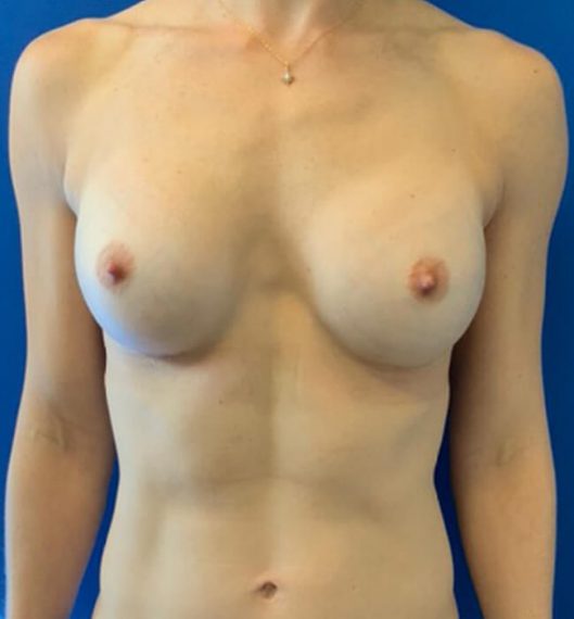 Breast Augmentation Patient 06 After