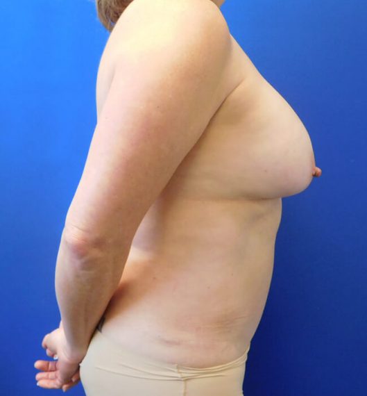 Breast Lift Patient 01 Before