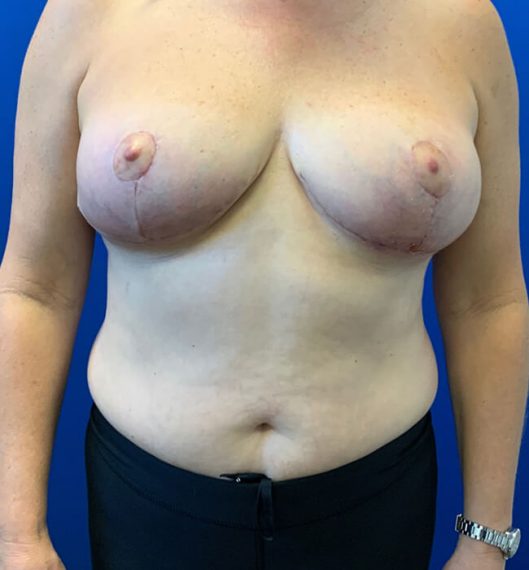 Breast Lift Patient 03 After