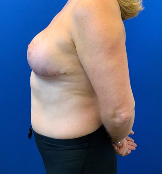 Breast Lift Patient 03 After
