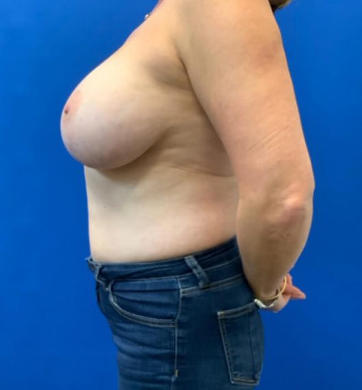 Breast Lift Patient 03 Before