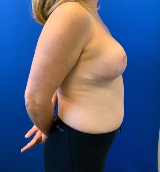 Breast Lift Patient 03 After