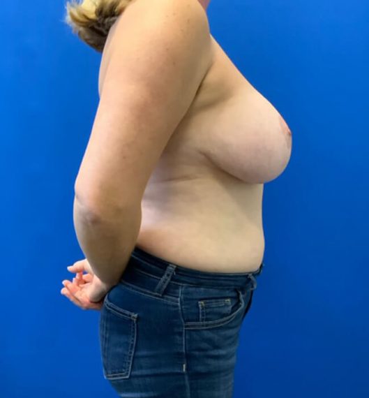 Breast Lift Patient 03 Before