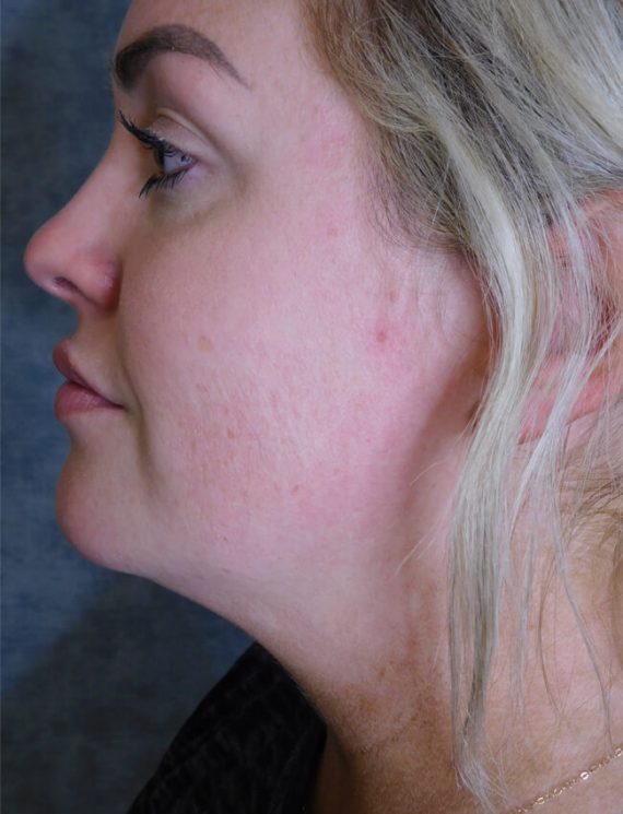 Chin Liposuction Patient 01 Before