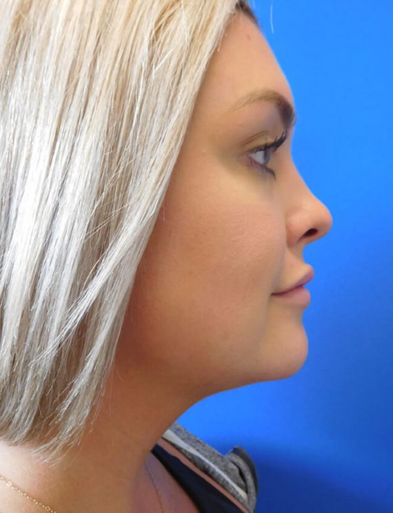 Chin Liposuction Patient 01 After