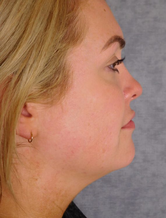 Chin Liposuction Patient 01 Before
