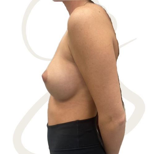 Breast Augmentation Patient 13 After