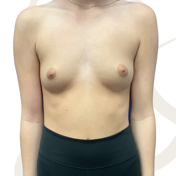 Breast Augmentation Patient 13 Before