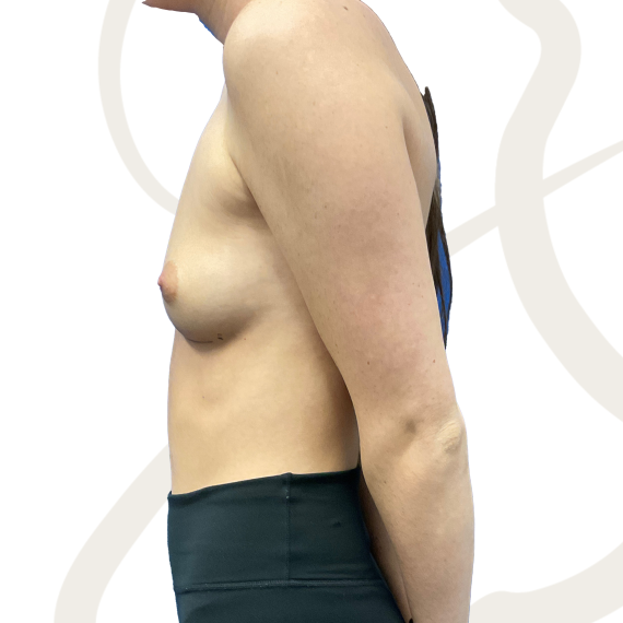 Breast Augmentation Patient 13 Before