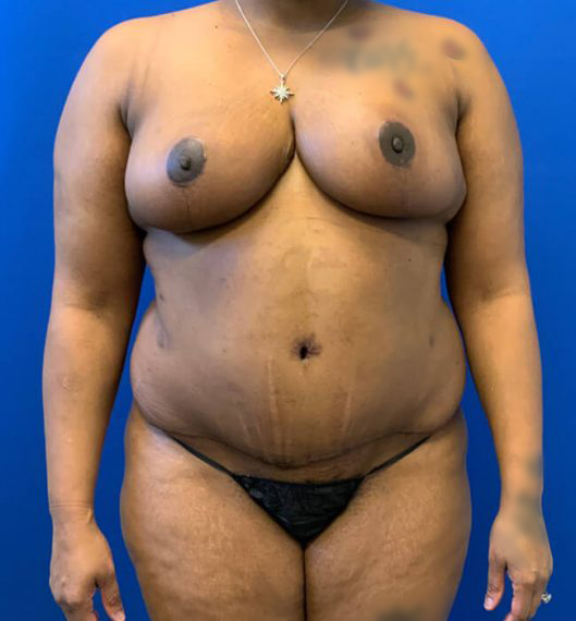 Breast Reduction Patient 02 After