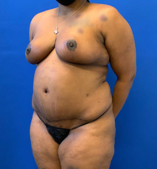 Breast Reduction Patient 02 After