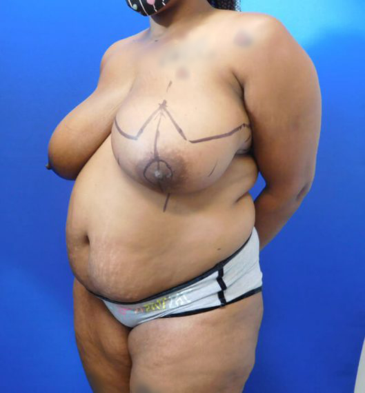 Breast Reduction Patient 02 Before