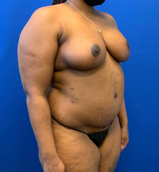 Breast Reduction Patient 02 After