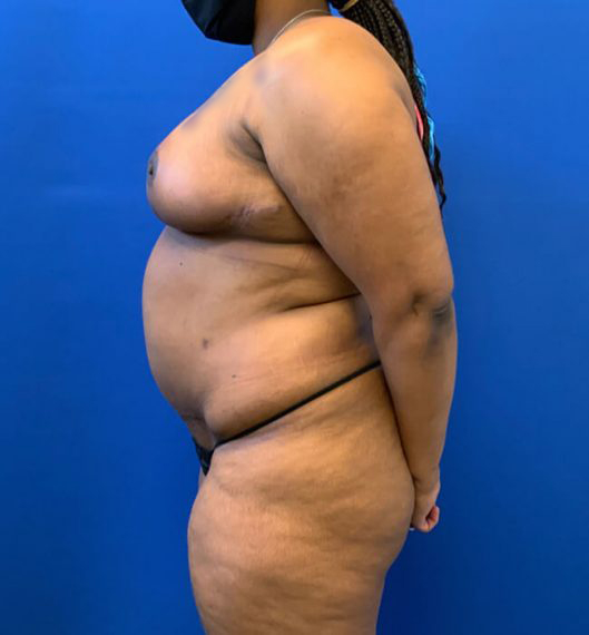 Breast Reduction Patient 02 After
